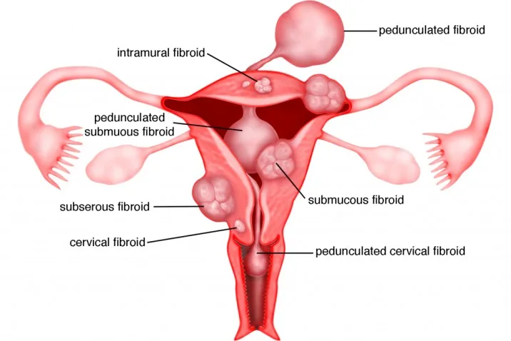 FIBROIDS FIBROMYOMAS