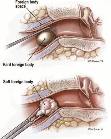 FOREIGN BODY IN THE EAR