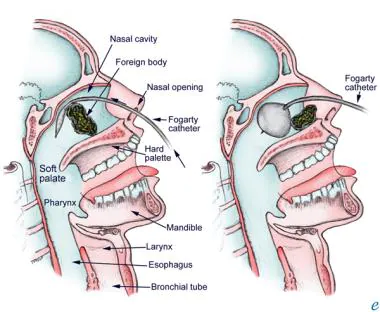 Foreign Bodies In The Nose