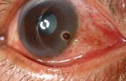 Foreign Body In The Eye