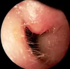 Furunculosis Of The External Ear Canal