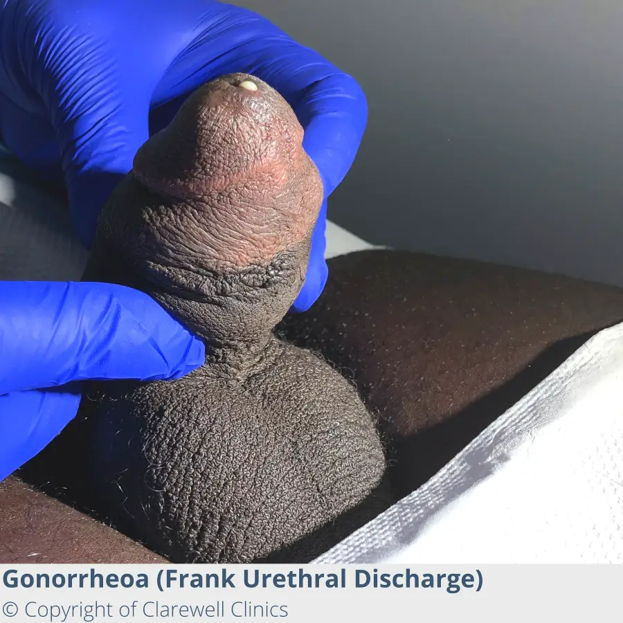 GONORRHOEA 1