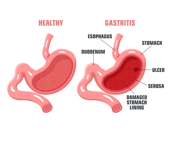 Gastritis