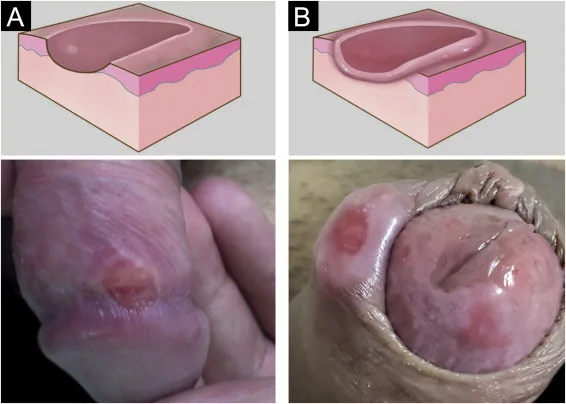 Genital Ulcer Syndrome