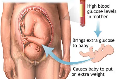 Gestational Diabetes E1703263154721