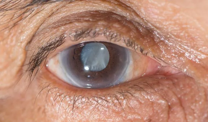 Glaucoma