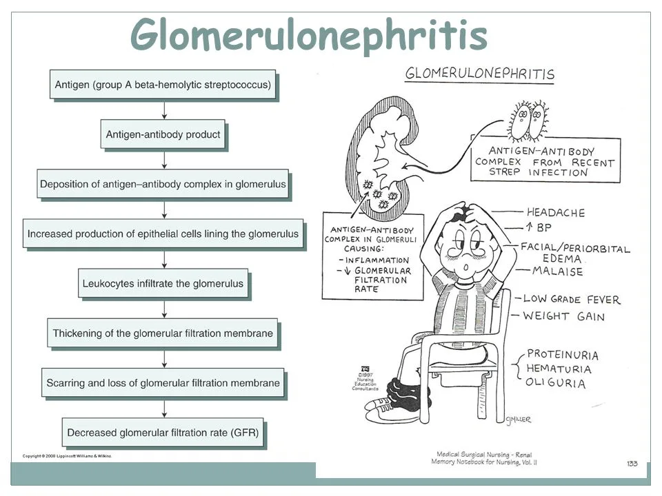 Glomerulonephritis