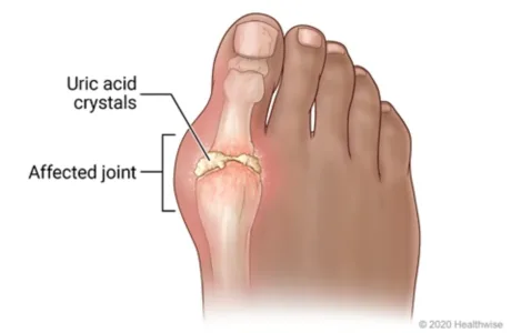 Gout