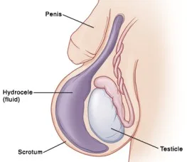Hydrocele