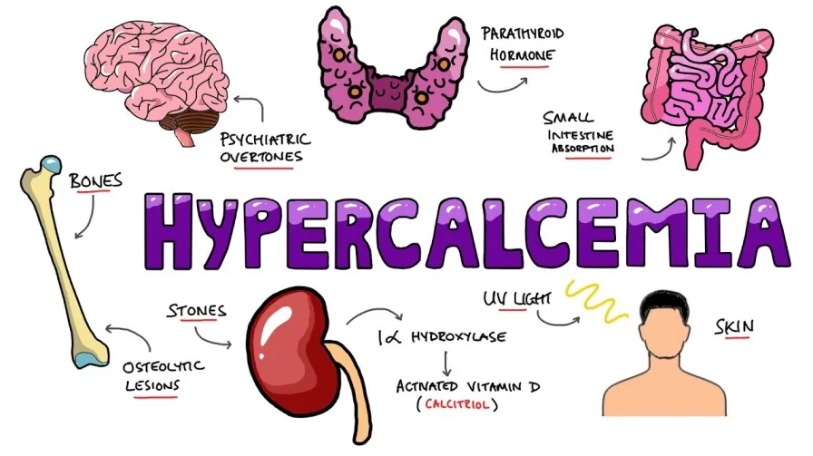 Hypercalcemia 1