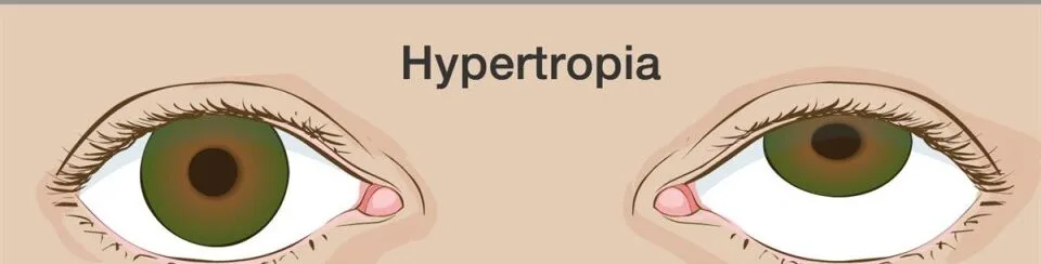 Hypertropia E1708525361572