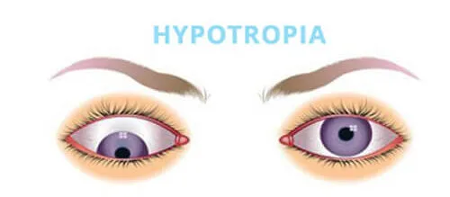 Hypotropia E1708525767347