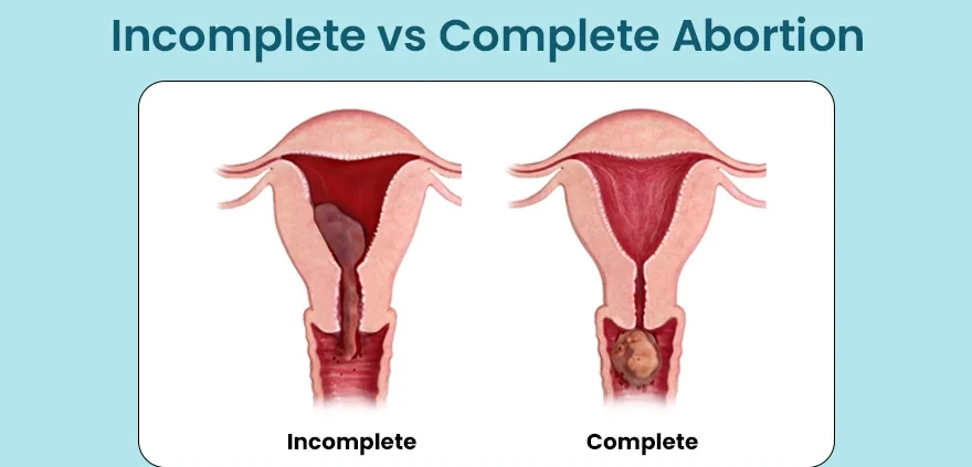 INCOMPLETE ABORTION Complete E1705416589988