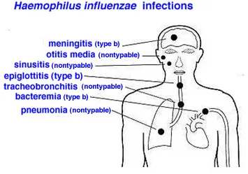 INFECTION