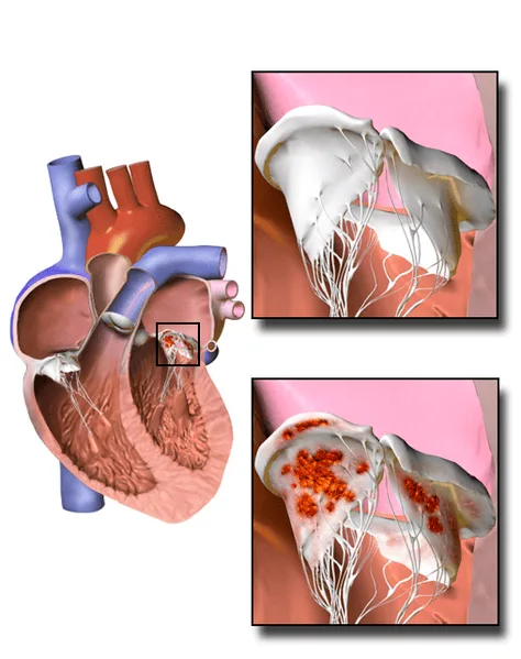 INFECTIVE ENDOCARDITIS Causes Investigations Management And Nursing Interventions 1