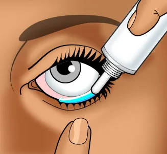 INSTILLATION OF EYE DROPS OINTMENT 1