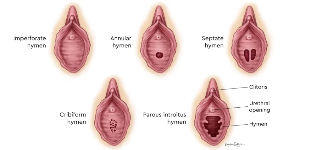Imperforate Hymen Types E1732549108188