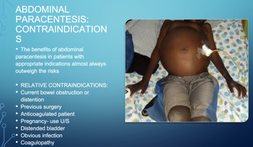Indications Of Abdominal Paracentesis