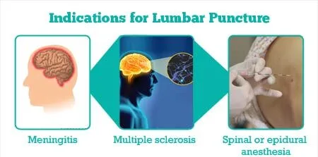 Indications Of Lumbar Puncture E1719464404385