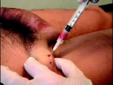 Inguinal Buboes Syndrome R