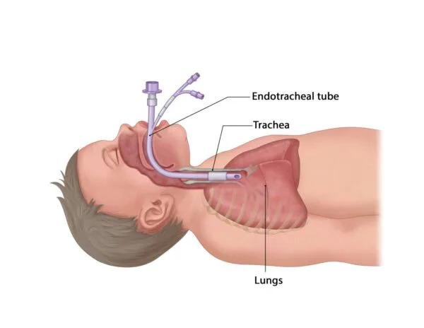 Intubation