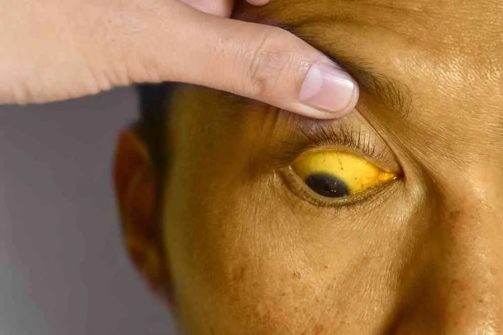JAUNDICE Hyperbilirubinemia 1