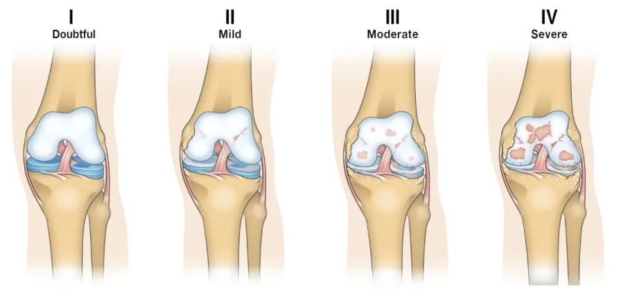 Kellgren Lawrence Stages Of Knee Osteoarthritis