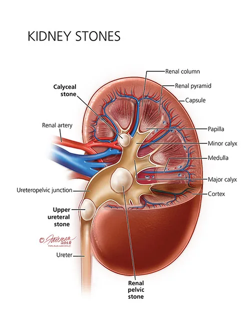 Kidney Stones Renal Calculi
