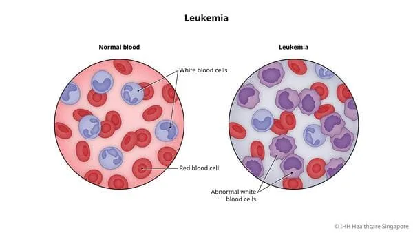 LEUKEMIA 1