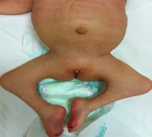 Labial Hypoplasia Nurses Revision