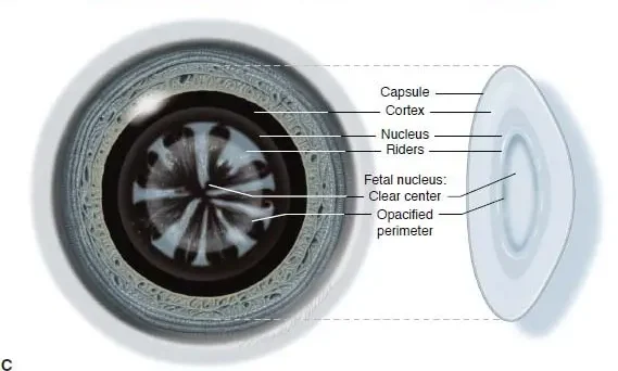 Lamellar Cataract E1708442084545