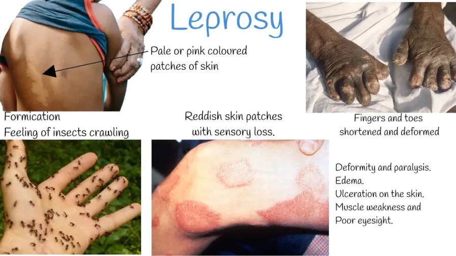 Leprosy 1