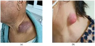 Lymphadenitis