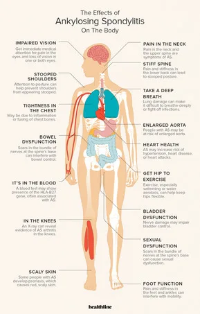MANIFESTATIONS Of Ankylosing Spondylitis