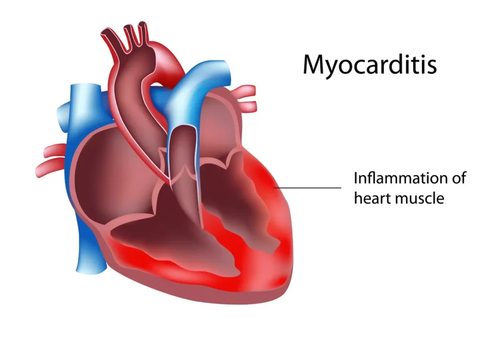 MYOCARDITIS Causes Investigations Management And Nursing Interventions