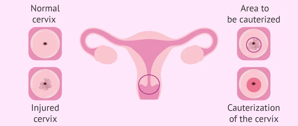 Management Of Cervical Erosion