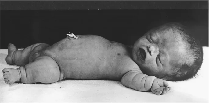 Management Of Dwarfism