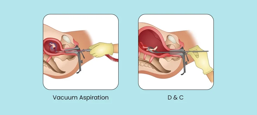 Management Of Incomplete Abortion E1705417161513