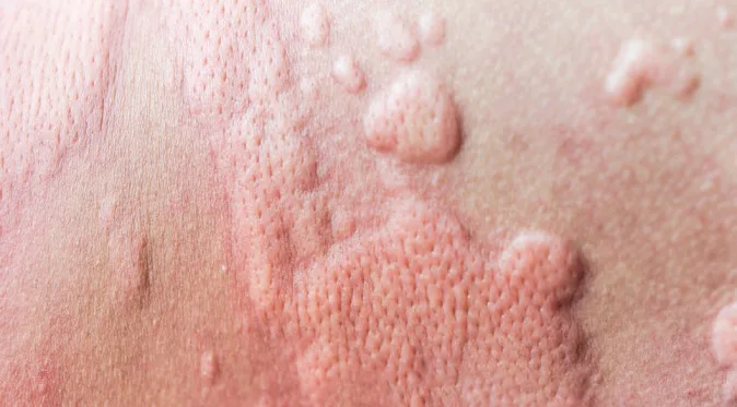 Management Of Skin Allergies