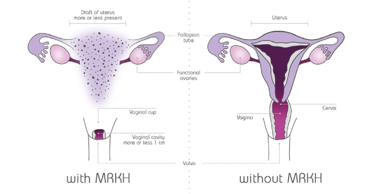 Mayer Rokitansky Kuster Hauser MRKH Syndrome