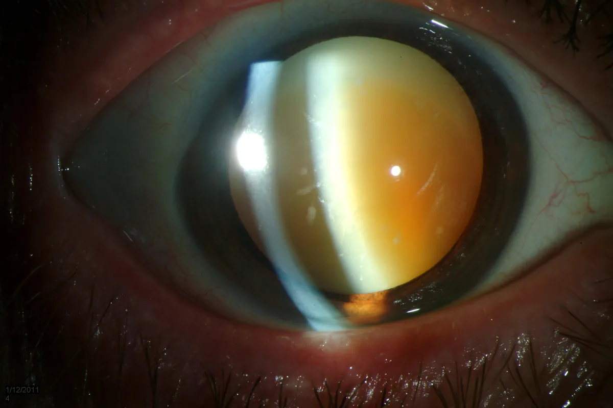 Morgagnian Cataract 2.JPG