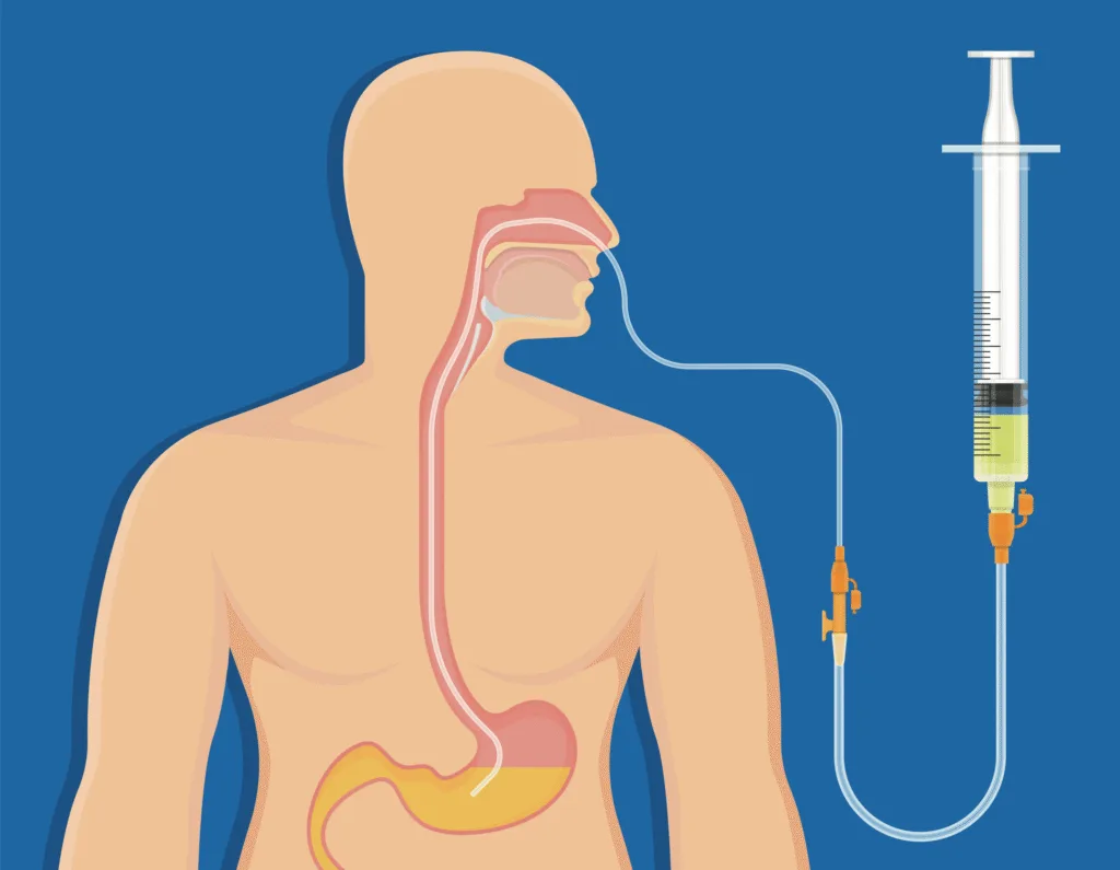 Naso Gastric Tube And Tube Feeding 1