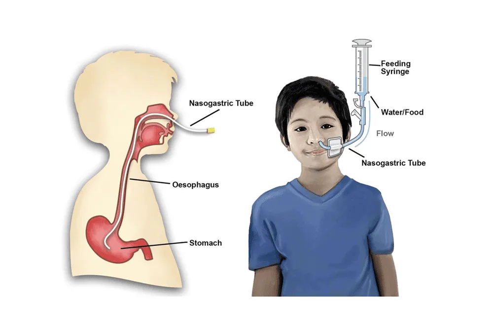 Nasogastric Tube Illustration 1