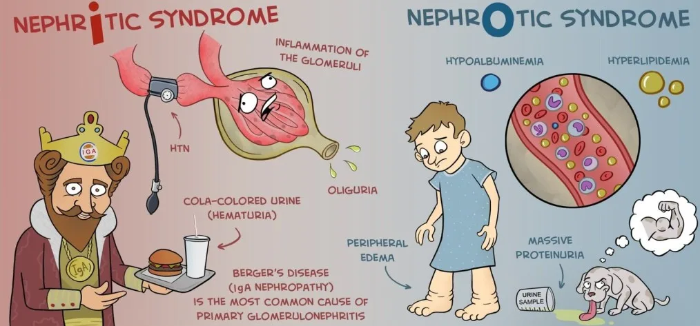 Nephritic Vs Nephrotic Syndrome 1