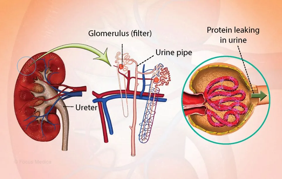 Nephrotic Syndrome Causes