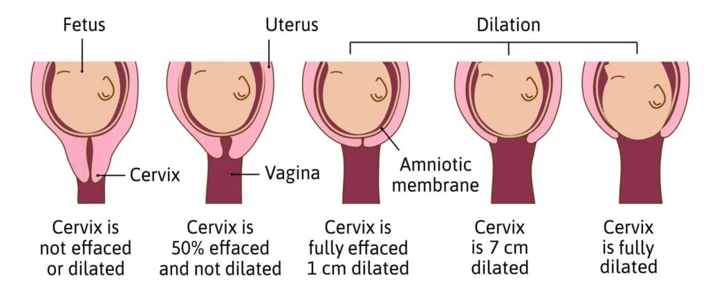 Normal First Stage Of Labour 1