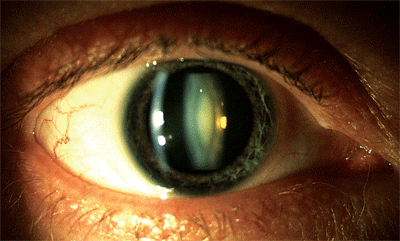 Nuclear Cataract