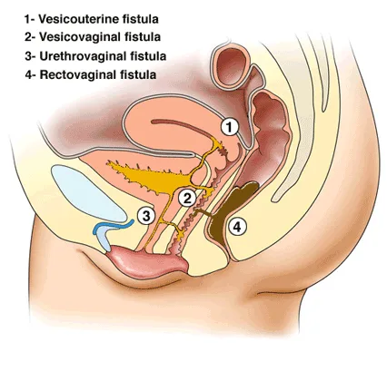 OBSTETRIC 1 VAGINAL FISTULA