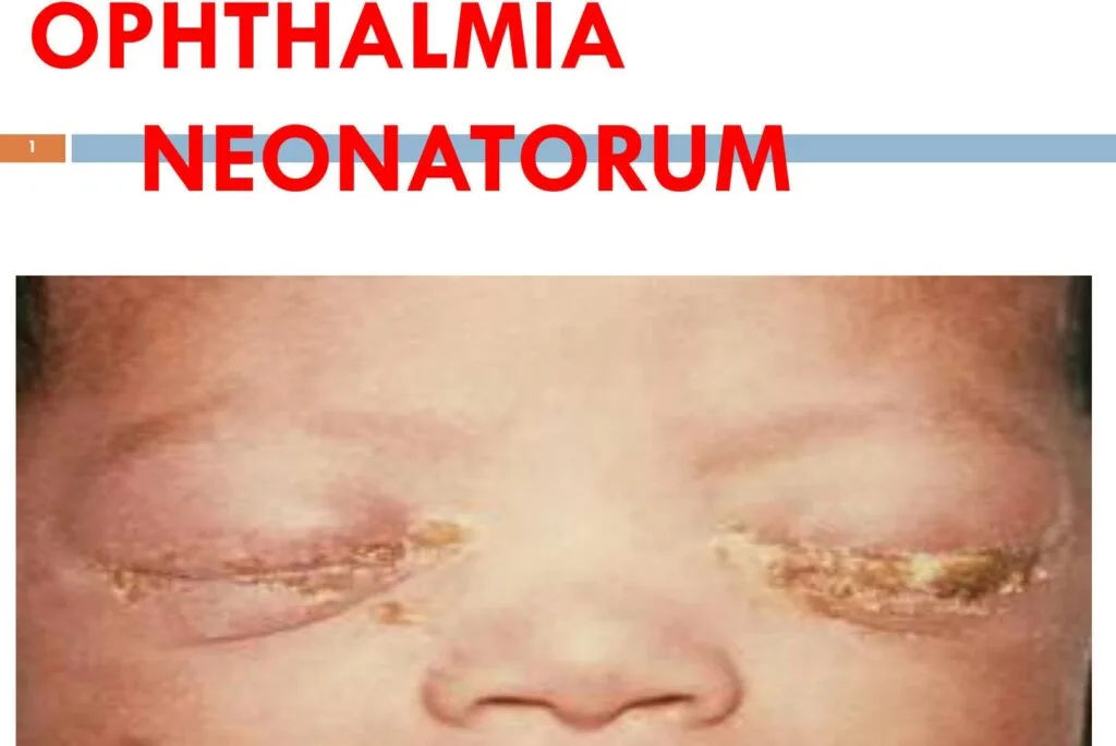 OPHTHALMIA NEONATORUM 1 E1732958135553