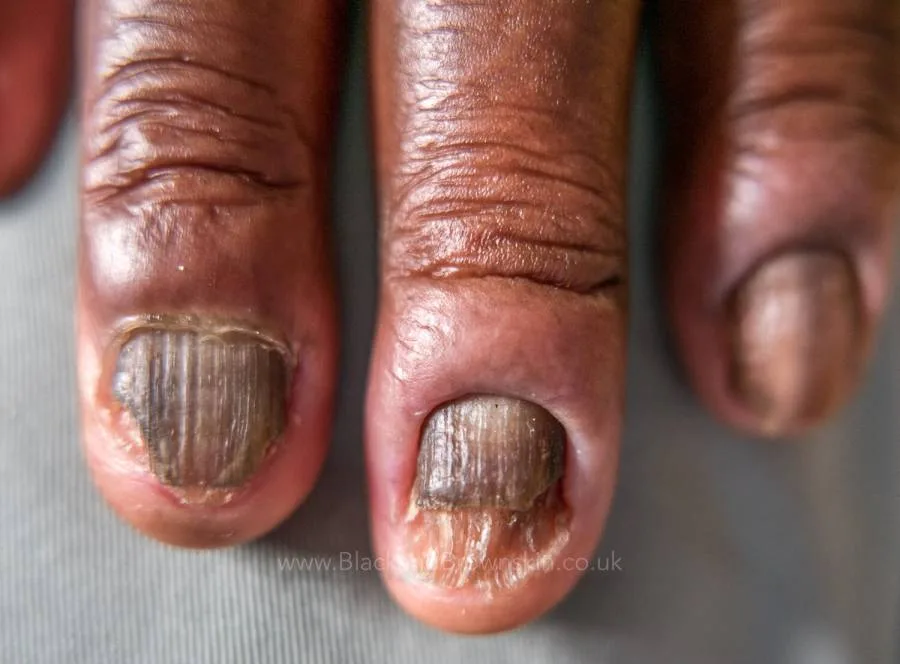 Onychomycosis